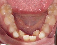 Teeth Before