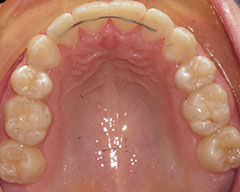 Teeth Before