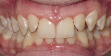Teeth Before