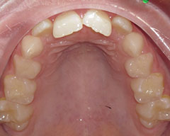 Teeth Before