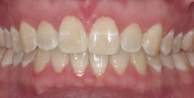 Teeth Before