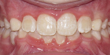 Teeth Before