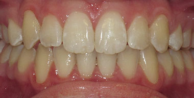 Teeth Before