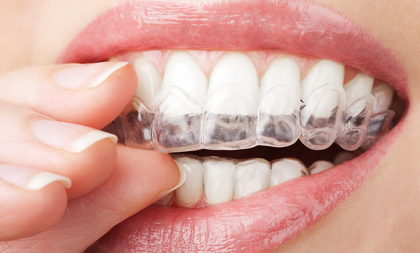 Invisalign – Undercover orthodontics Invisalign – Undercover orthodontics