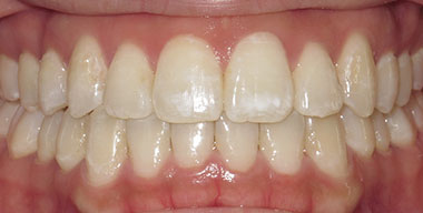 Teeth Before