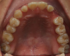 Teeth Before