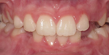 Teeth Before