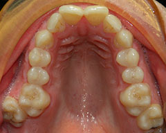 Teeth Before
