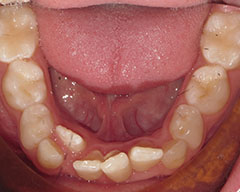 Teeth Before