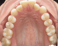 Teeth Before