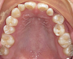 Teeth Before