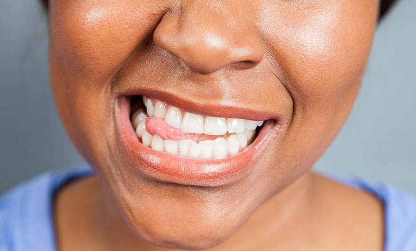 Can I Straighten Just My Front Teeth? Can I Straighten Just My Front Teeth?
