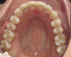 Teeth Before