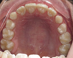 Teeth Before