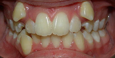Teeth Before