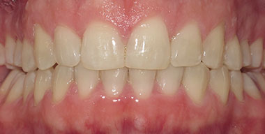 Teeth Before