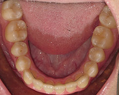 Teeth Before