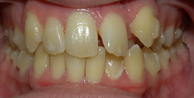 Teeth Before