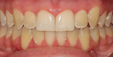 Teeth Before