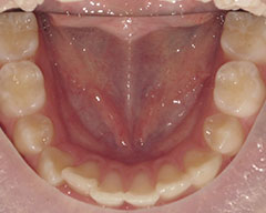 Teeth Before