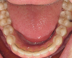 Teeth Before