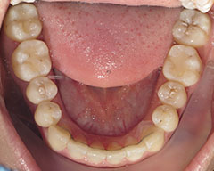 Teeth Before