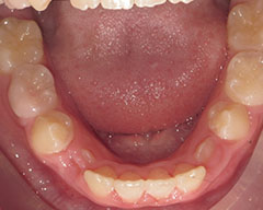 Teeth Before