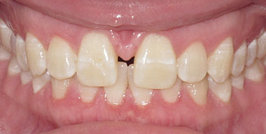 Teeth Before
