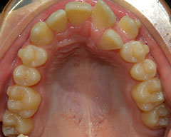 Teeth Before