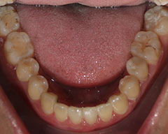 Teeth Before