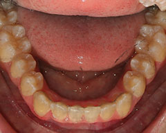 Teeth Before