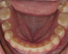 Teeth Before