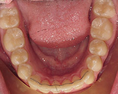 Teeth Before