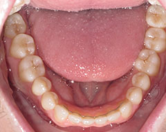 Teeth Before