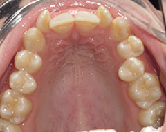 Teeth Before