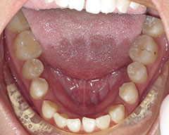 Teeth Before