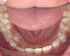 Teeth Before