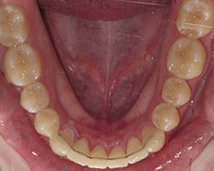 Teeth Before