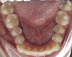 Teeth Before