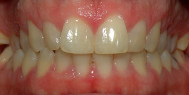 Teeth Before