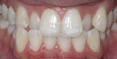 Teeth Before