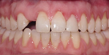 Teeth Before