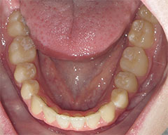 Teeth Before