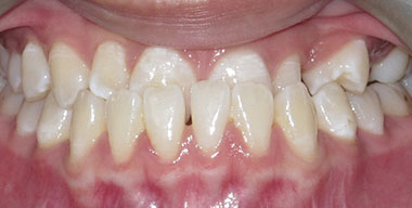 Teeth Before