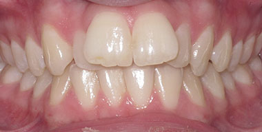 Teeth Before