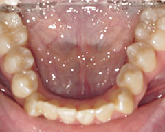 Teeth Before