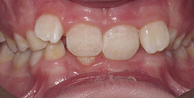 Teeth Before
