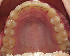 Teeth Before