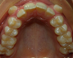 Teeth Before