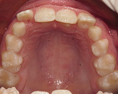 Teeth Before